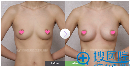 上海华美李健假体隆胸案例 上海华美李健假体隆胸案例