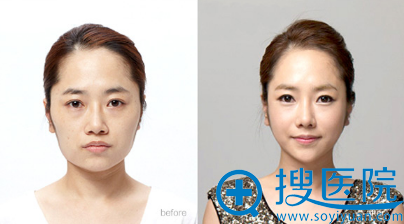 上海华美李志海长曲线下颌角案例 上海华美李志海长曲线下颌角案例