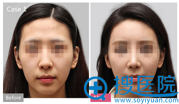 上海华美姜胜勋自体脂肪移植案例 上海华美姜胜勋自体脂肪移植案例