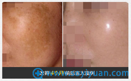 上海华美田波黄褐斑案例 上海华美田波黄褐斑案例