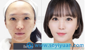 上海华美常春祛痘案例 上海华美常春祛痘案例