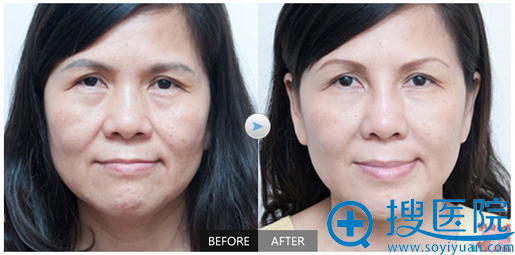 上海华美杨定宇面部除皱案例 上海华美杨定宇面部除皱案例