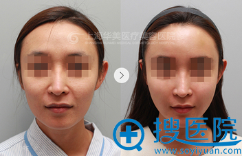 上海华美陈颖面部线雕提拉案例 上海华美陈颖面部线雕提拉案例