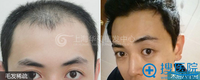 上海华美王书闳植发案例 上海华美王书闳植发案例