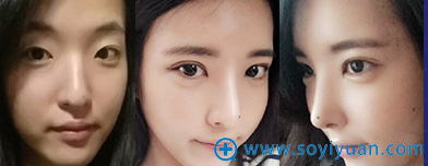 上海华美杨亚益park法双眼皮案例 上海华美杨亚益park法双眼皮案例