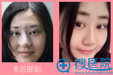 上海华美叶丽萍鼻综合案例 上海华美叶丽萍鼻综合案例