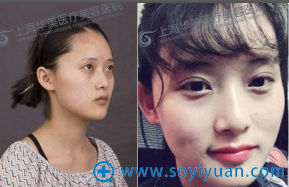 上海华美张朋双眼皮案例 上海华美张朋双眼皮案例