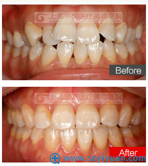 上海华美张晓峰透明隐形牙齿矫正案例 上海华美张晓峰透明隐形牙齿矫正案例