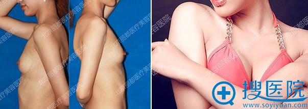 北京丽都石冰的假体隆胸案例 北京丽都石冰的假体隆胸案例