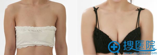 八大处做隆胸医生栾杰的案例 八大处做隆胸医生栾杰的案例