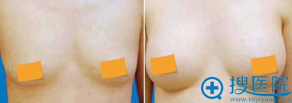 北京亚馨美莱坞何照华隆胸案例 北京亚馨美莱坞何照华隆胸案例