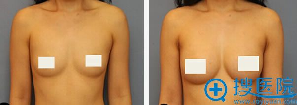 常冬青进行假体隆胸案例图 常冬青进行假体隆胸案例图
