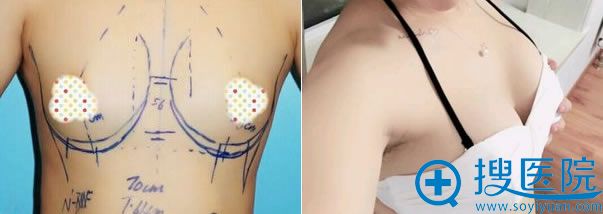 北京协和整形曾昂的隆胸案例 北京协和整形曾昂的隆胸案例