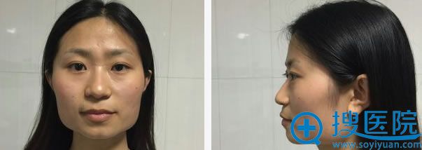 在北京八大处做颧骨和下颌角前 在北京八大处做颧骨和下颌角前