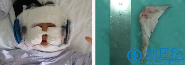 做颧骨内推和下颌角切除第1天 做颧骨内推和下颌角切除第1天