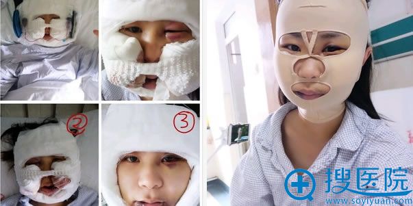 颧骨内推手术前4天恢复过程图 颧骨内推手术前4天恢复过程图
