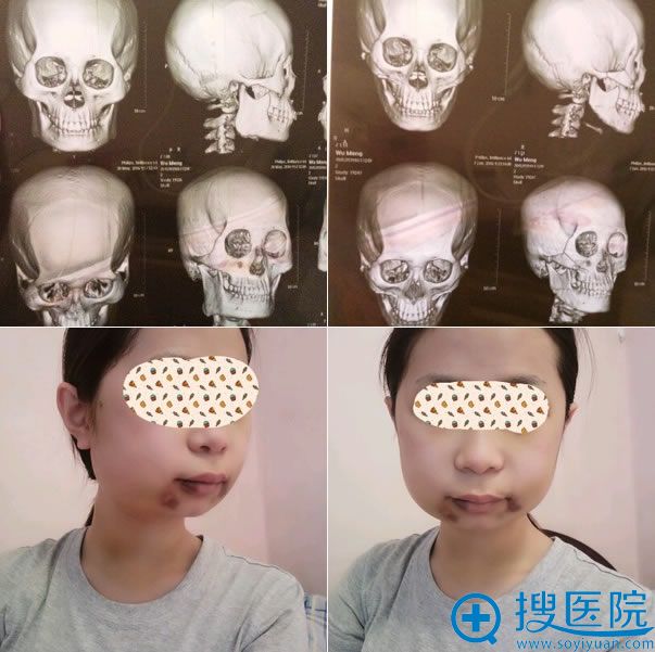 颧骨和下颌角整形手术第6天 颧骨和下颌角整形手术第6天