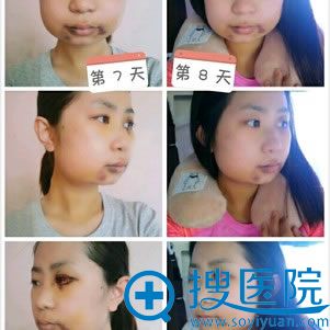 做颧骨和下颌角手术第8天 做颧骨和下颌角手术第8天