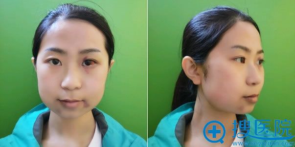 做颧骨内推手术第12天 做颧骨内推手术第12天