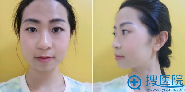 北京八大处做颧骨30天效果怎么样 北京八大处做颧骨30天效果怎么样