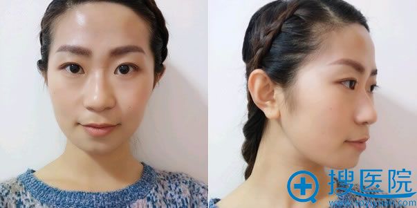 做颧骨和下颌角4个月照片 做颧骨和下颌角4个月照片