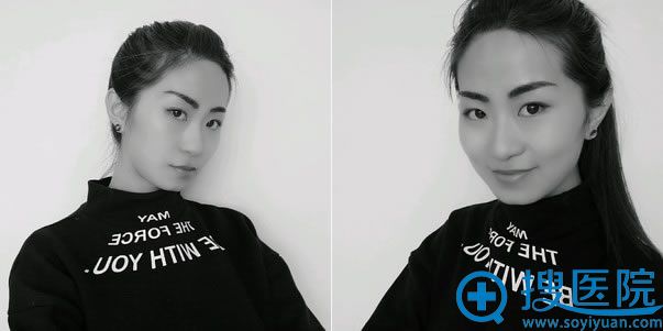 颧骨手术8个月的效果 颧骨手术8个月的效果