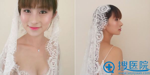 颧骨和下颌角手术1年效果 颧骨和下颌角手术1年效果