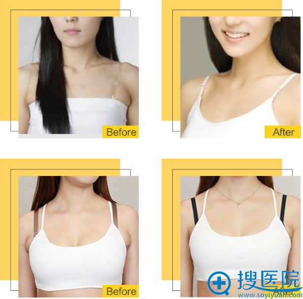 北京雅韵副乳吸脂塑形案例 北京雅韵副乳吸脂塑形案例