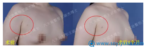 八大处整形王淑杰副乳吸脂术后四个月效果 八大处整形王淑杰副乳吸脂术后四个月效果