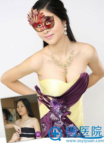 宁波尚美假体隆胸真实案例 宁波尚美假体隆胸真实案例