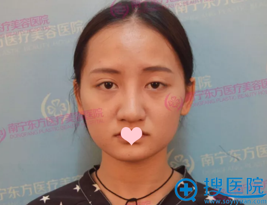 鼻综合失败修复术前照片 鼻综合失败修复术前照片