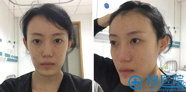 在北京八大处做下巴手术前 在北京八大处做下巴手术前