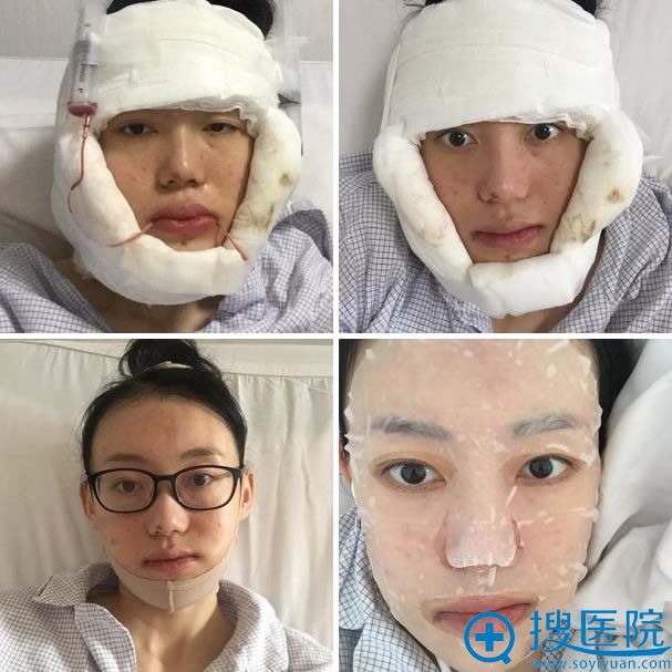 八大处下巴整形前5天恢复图 八大处下巴整形前5天恢复图