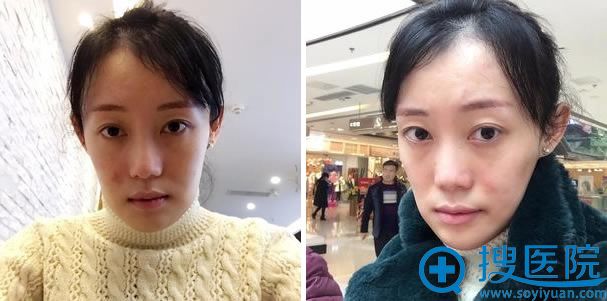 瓜子脸整形手术20天拆线照 瓜子脸整形手术20天拆线照