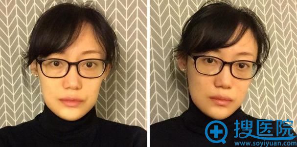 做下巴整形手术第27天 做下巴整形手术第27天