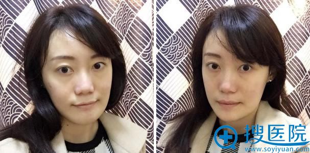 八大处解芳vline瓜子脸整形手术第90天 八大处解芳vline瓜子脸整形手术第90天