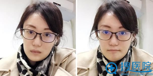 下巴整形手术第4个月效果 下巴整形手术第4个月效果