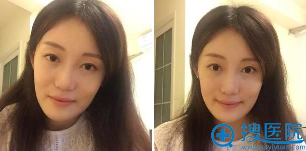 vline瓜子脸整形手术第190天 vline瓜子脸整形手术第190天