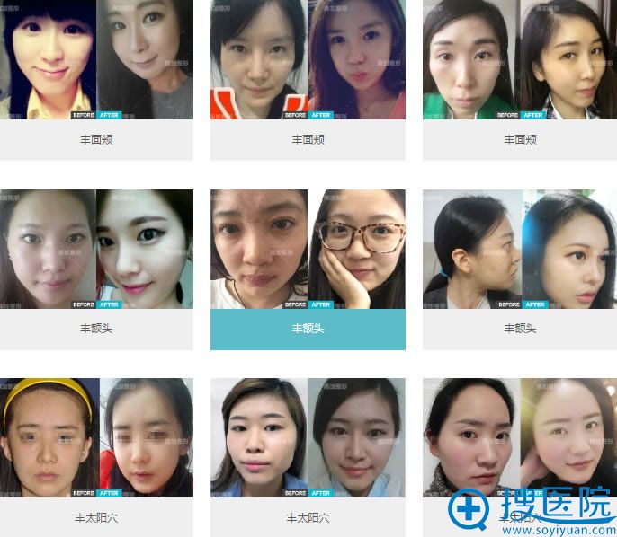 北京南加国际整形医院真人案例 北京南加国际整形医院真人案例