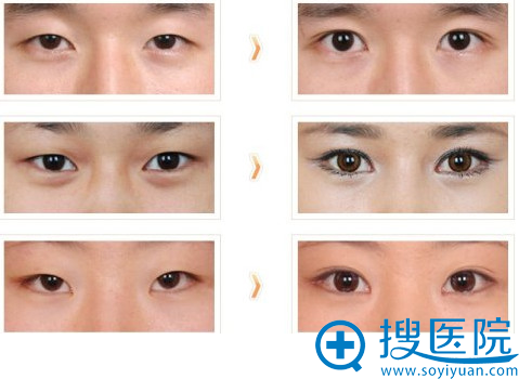 韩国清潭整形医院成镇模做的双眼皮案例 韩国清潭整形医院成镇模做的双眼皮案例