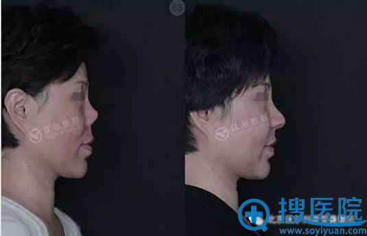 北京沃尔刘彦军短鼻修复案例效果图 北京沃尔刘彦军短鼻修复案例效果图