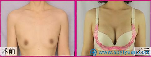 烟台华怡张苹院长隆胸案例对比图 烟台华怡张苹院长隆胸案例对比图