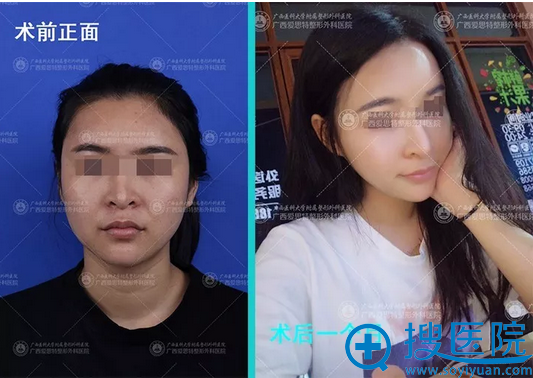 广西南宁爱思特高伟教授磨颧骨案例前后对比图 广西南宁爱思特高伟教授磨颧骨案例前后对比图
