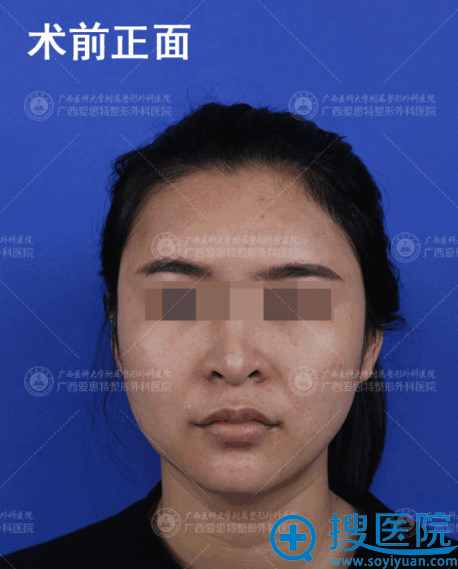 磨骨术前照片 磨骨术前照片