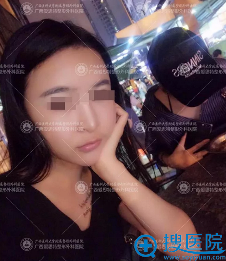 去广西南宁爱思特找高伟做完磨骨半个月图片 去广西南宁爱思特找高伟做完磨骨半个月图片