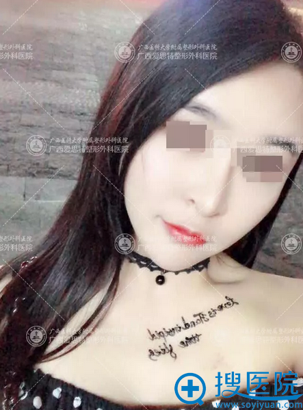 广西南宁爱思特高伟削骨案例术后一个月图片 广西南宁爱思特高伟削骨案例术后一个月图片