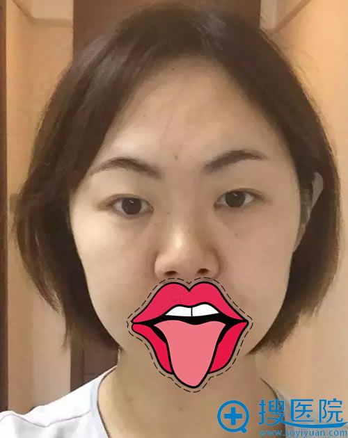 做隆鼻和双眼皮的手术前照片 做隆鼻和双眼皮的手术前照片