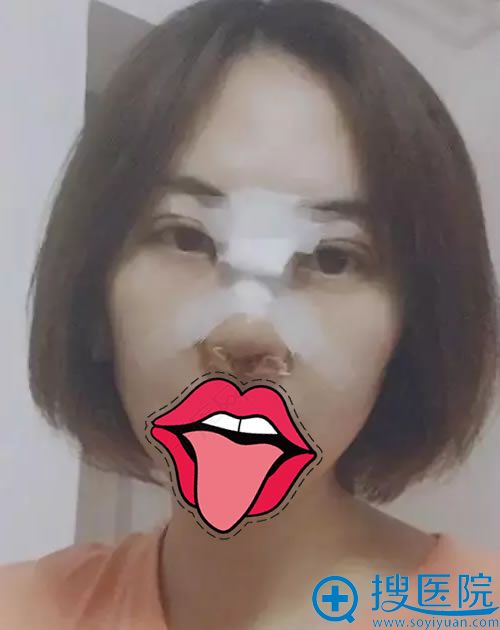 刚做完双眼皮和隆鼻手术的照片 刚做完双眼皮和隆鼻手术的照片