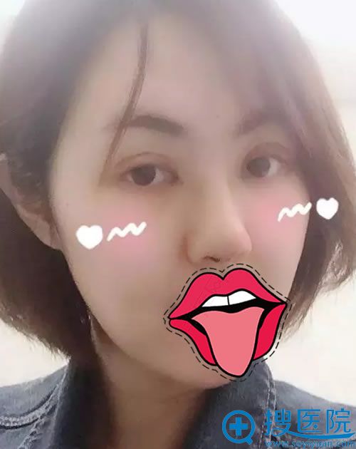 在伊美尔做完隆鼻和双眼皮7天后 在伊美尔做完隆鼻和双眼皮7天后