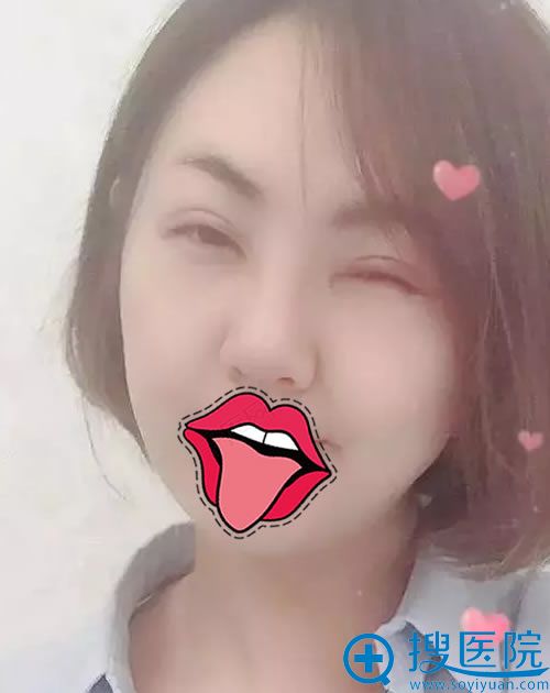 伊美飞王飞隆鼻案例10天恢复效果 伊美飞王飞隆鼻案例10天恢复效果